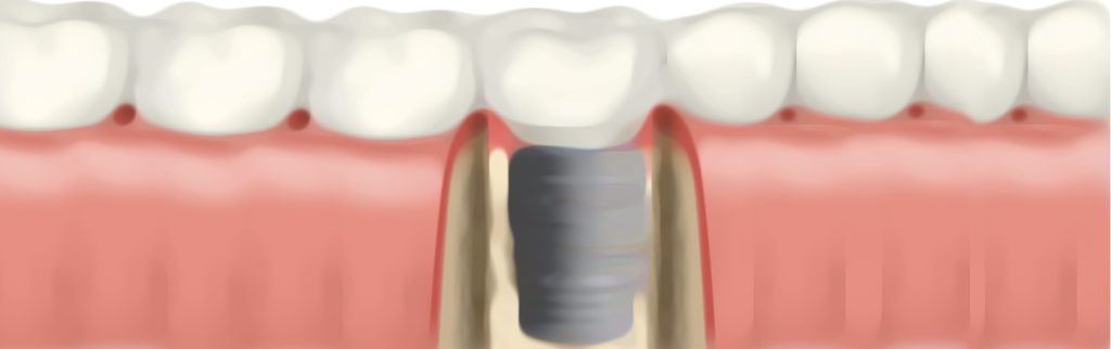 Zahn-Implantat im Kiefer